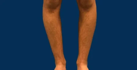 تكلفة عملية تقوس الساقين