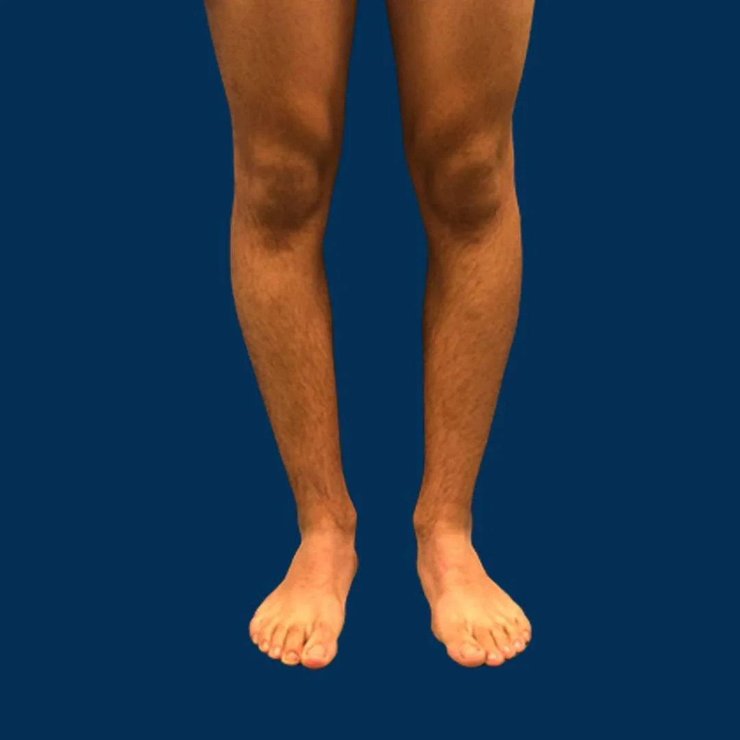 تكلفة عملية تقوس الساقين