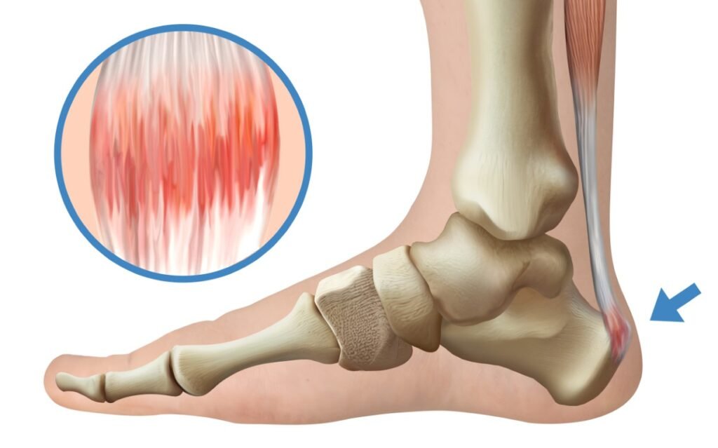تمزق وتر أخيل (وتر العرقوب)