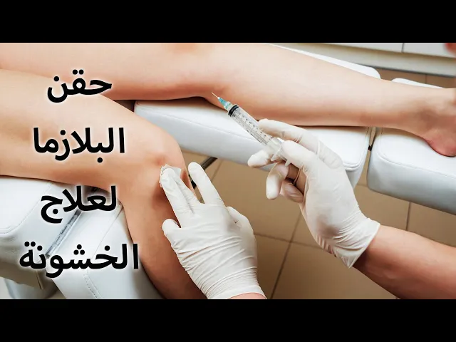 حقن البلازما لعلاج خشونة الركبة