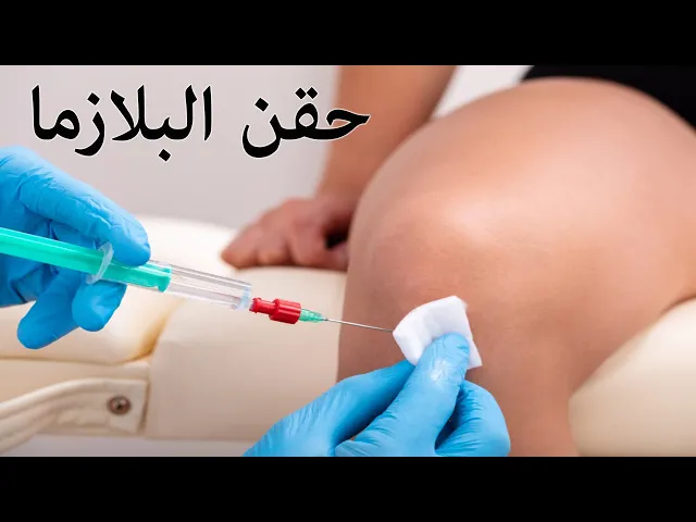 حقن البلازما للمفاصل