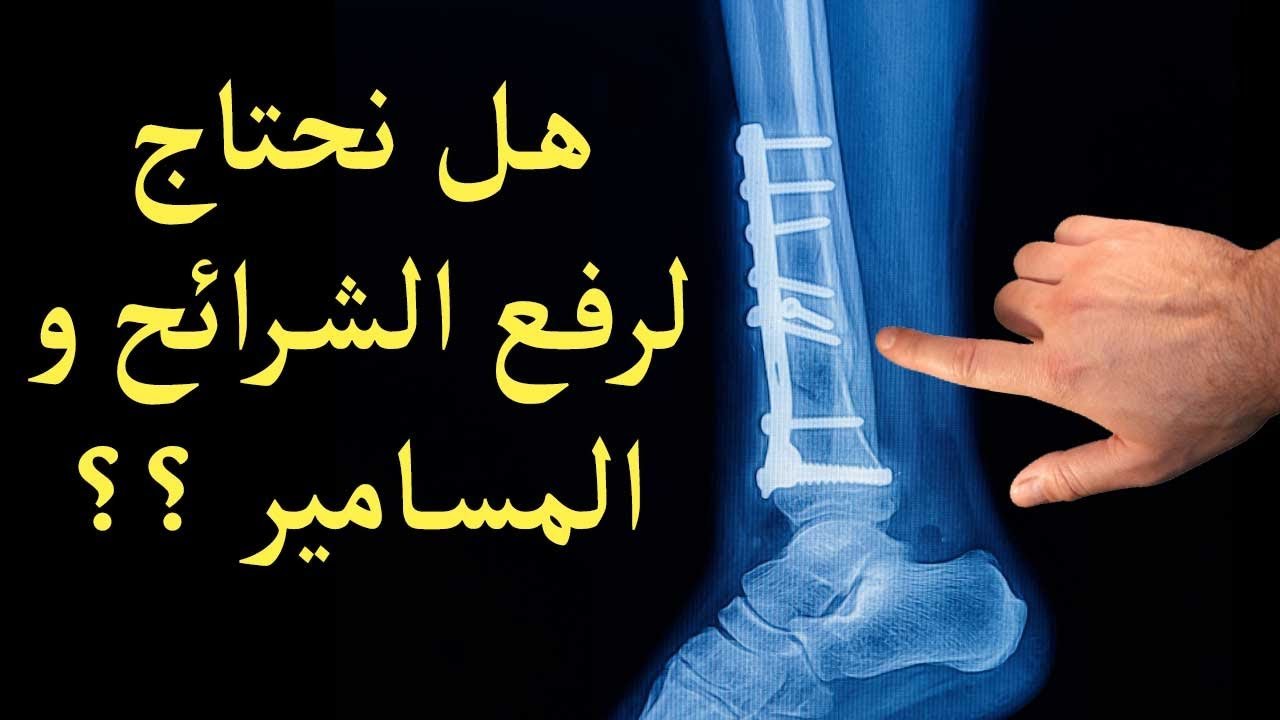 ازالة الشرائح والمسامير