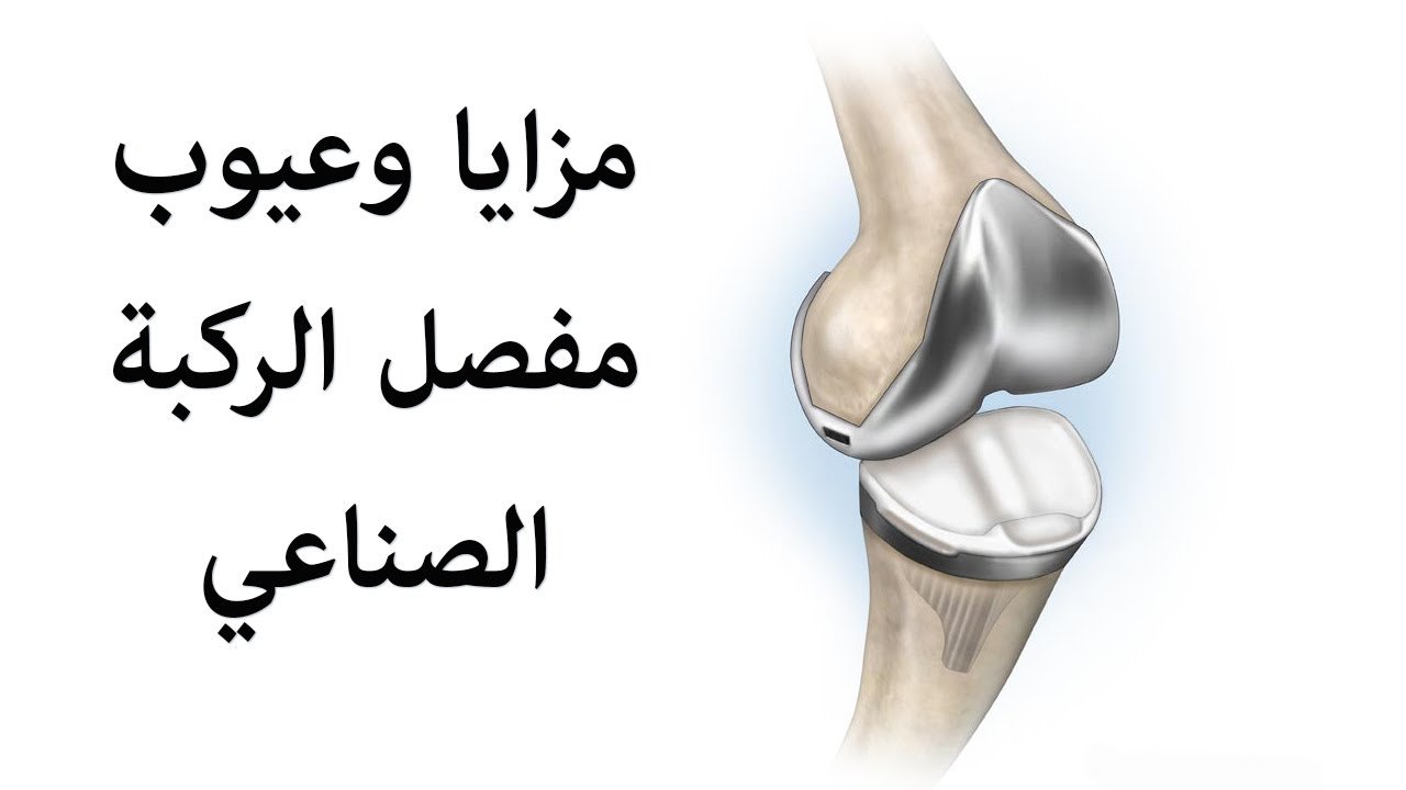 عملية تغير مفصل الركبة