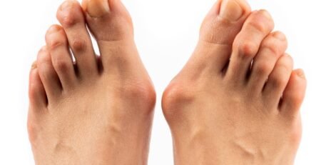 علاج بروز عظمة ابهام القدم​