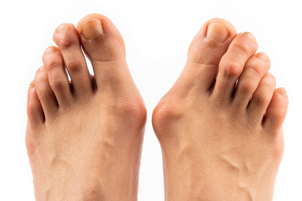 علاج بروز عظمة ابهام القدم​