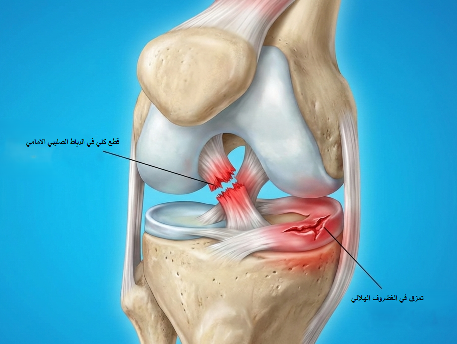 اصابة الرباط الصليبي يصاحبها تمزق في الغضروف الهلالي