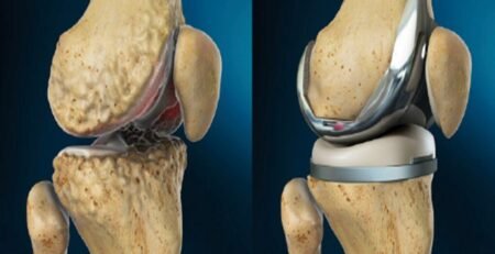 افضل دكتور تغيير مفصل الركبة في مصر