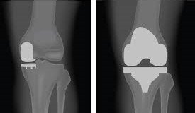 التغيير الكلي (اليمين) والجزئي (اليسار) لمفصل الركبة