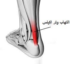 التهاب وتر اكيلس