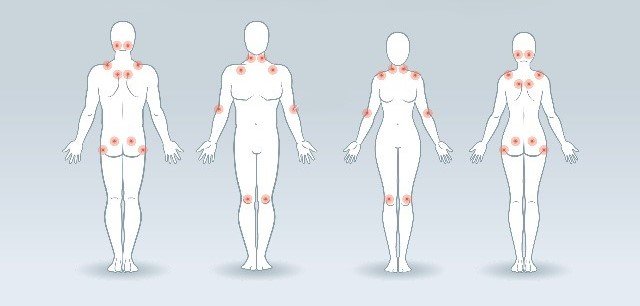 انتشار نقاط الألم في الجسم من اعراض الالم العضلي الليفي