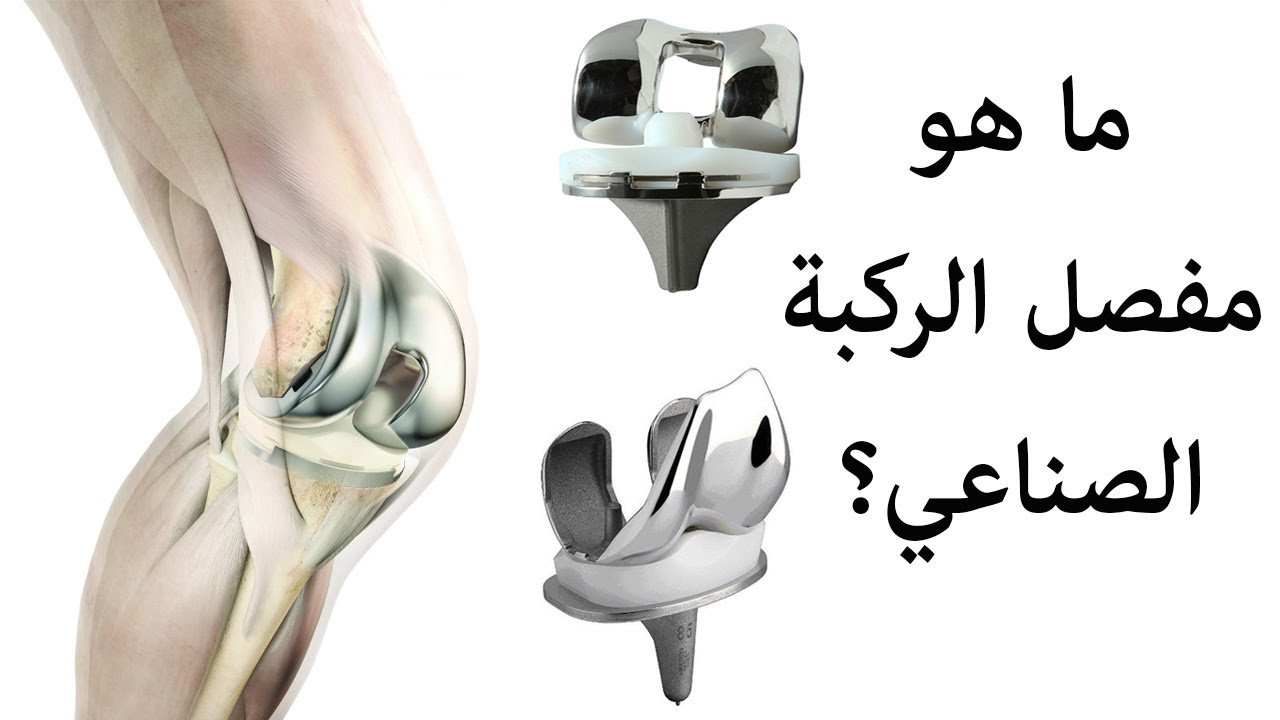 مفصل الركبة الصناعي