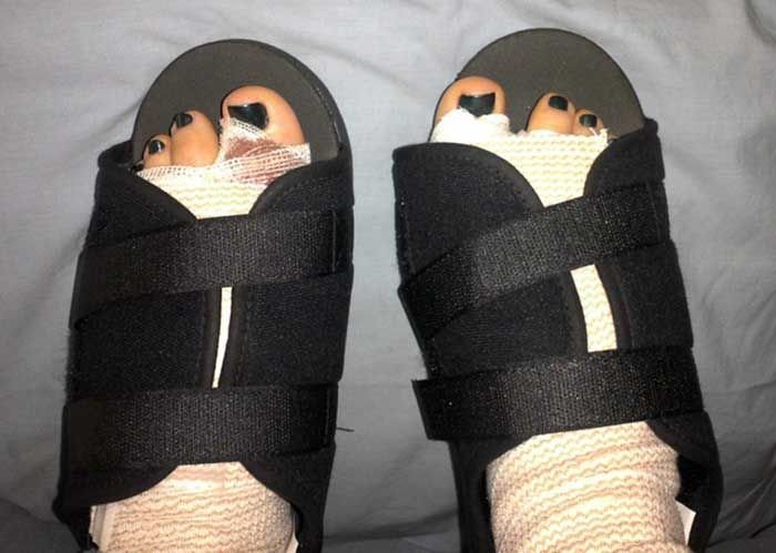 حذاء طبي خاص للارتداء في اول اسبوعين بعد جراحة بروز عظمة ابهام القدم