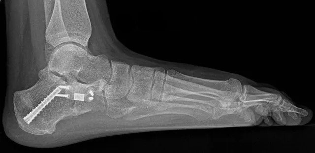 دمج العظام أحد طرق اجراء عملية الفلات فوت