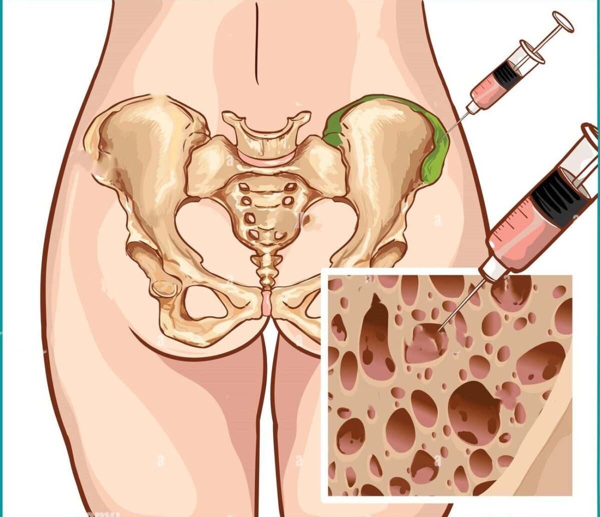 سحب نخاع العظام من عظام الحوض