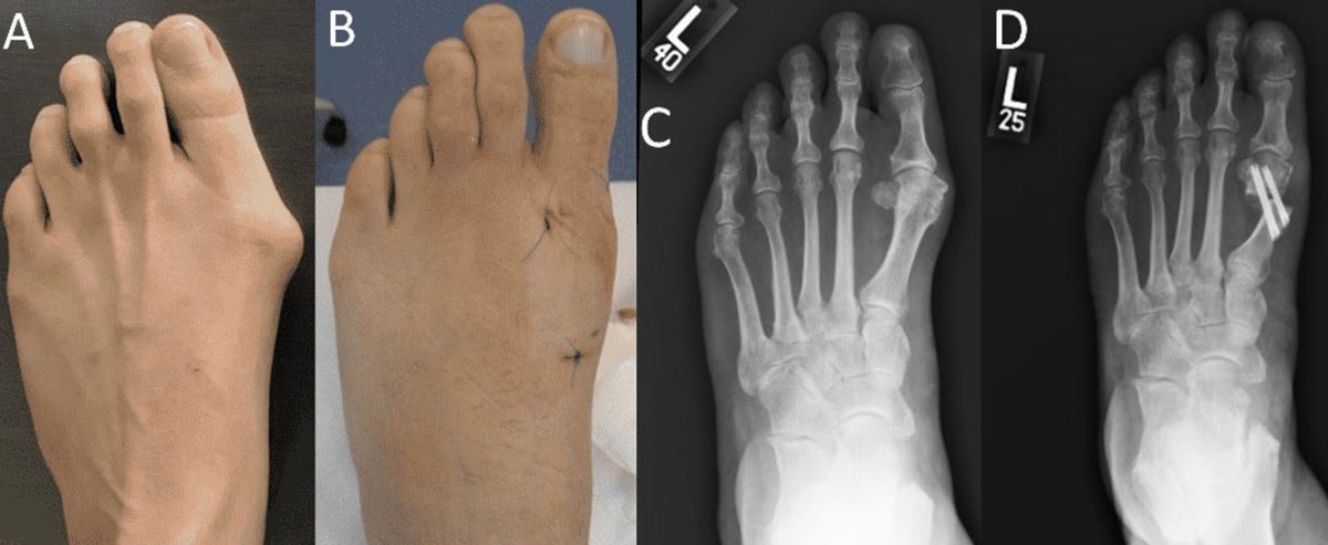 علاج بروز عظمة ابهام القدم بتقنية الجراحة طفيفة التوغل
