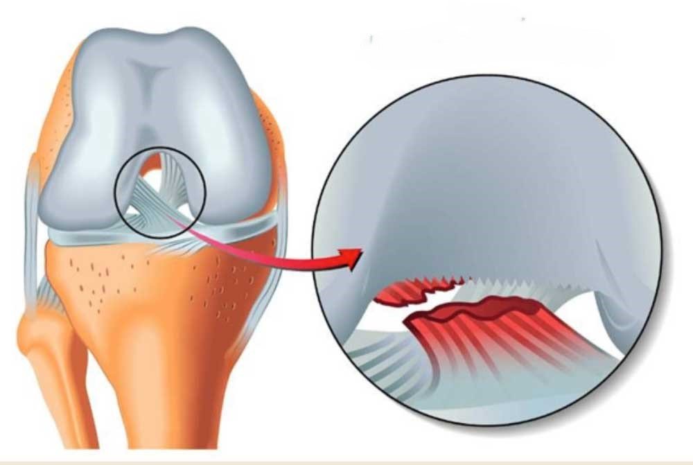 قطع الرباط الصليبي الامامي