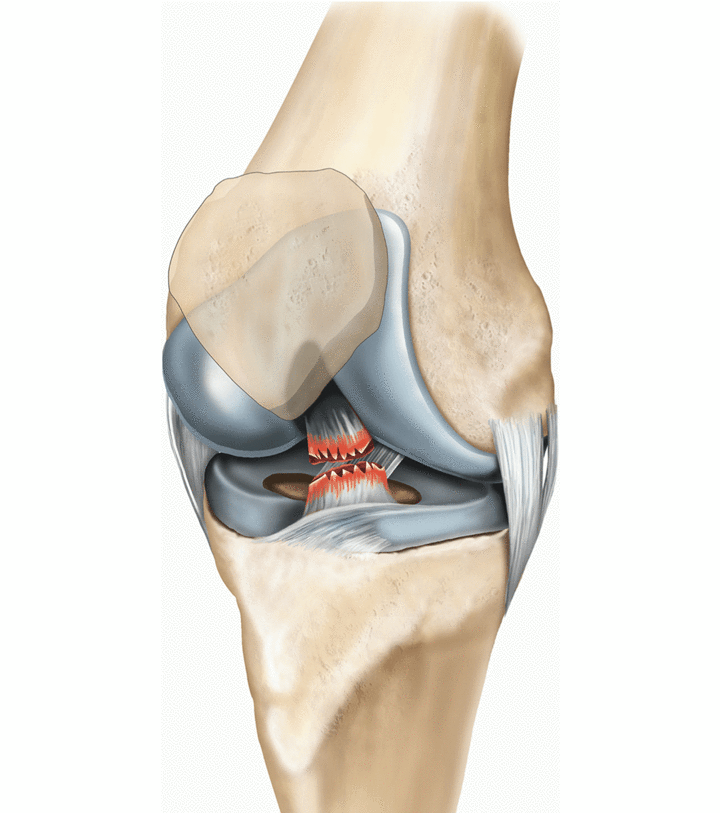 قطع كامل في الرباط الصليبي