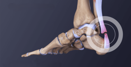 قطع وتر اكيلس