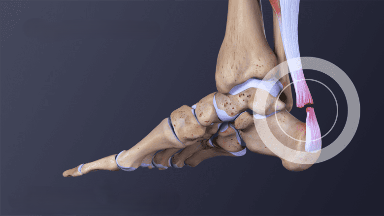 قطع وتر اكيلس