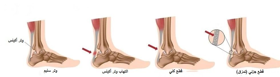 قطع وتمزق وتر أكيلس
