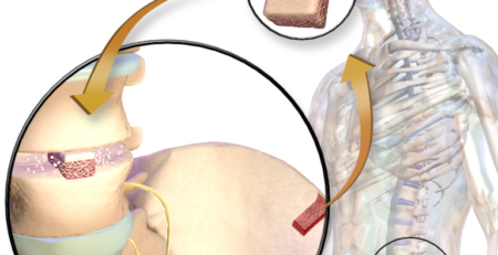 عملية ترقيع العظام