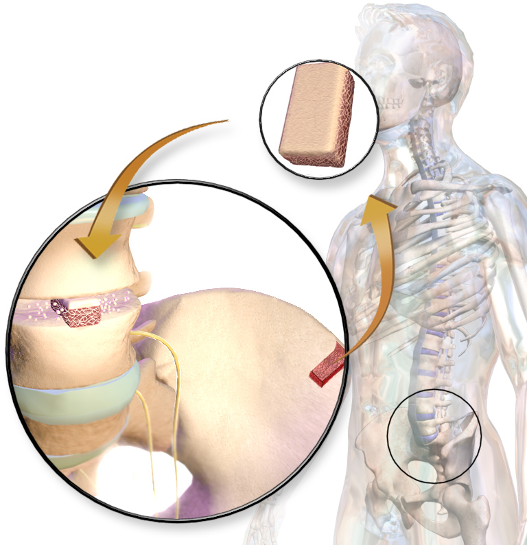 عملية ترقيع العظام