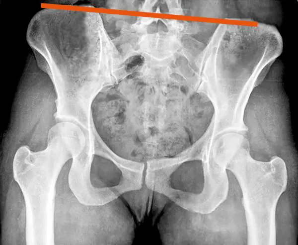 أشعة سينية تُظهر ميل الحوض الجانبي بوضوح