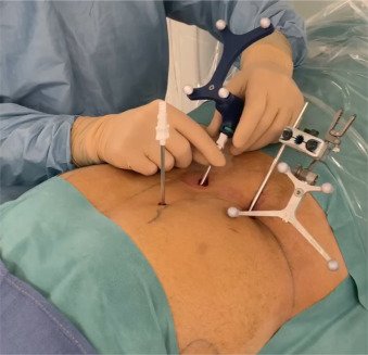 الحقن الموضعي الموجه بالأشعة