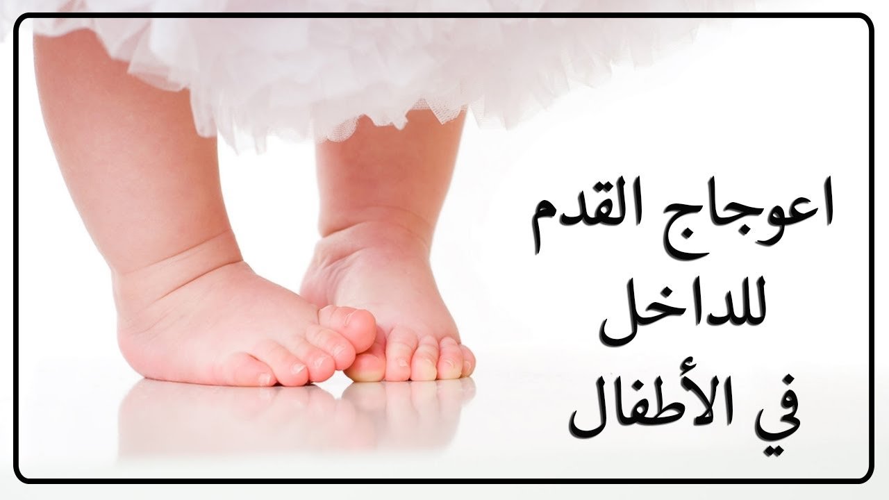 إعوجاج القدم للداخل فى الأطفال