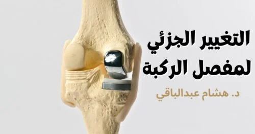 التغيير الجزئي لمفصل الركبة
