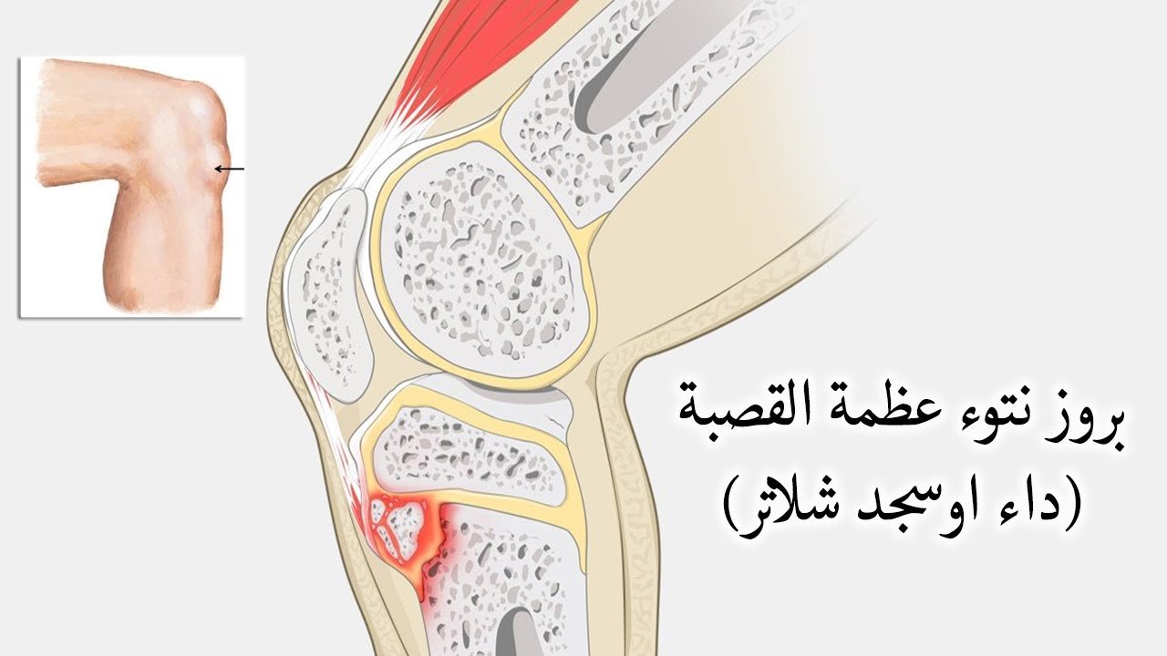 بروز نتوء عظمة القصبة