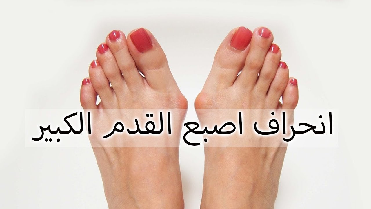 علاج انحراف اصبع القدم الكبير
