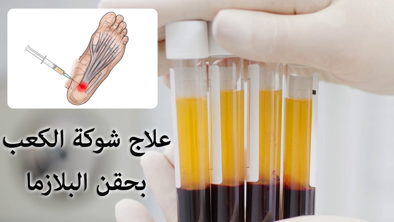 علاج الشوكة العظمية​