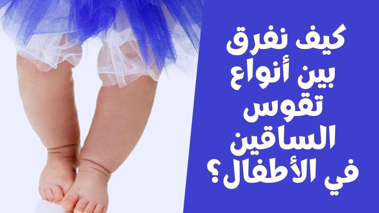 انواع تقوس الساقين عند الاطفال​