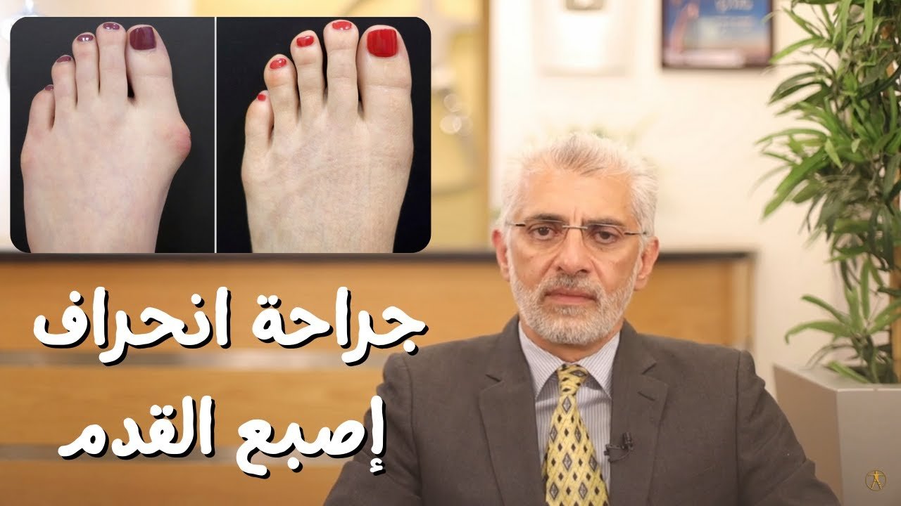 علاج انحراف اصبع القدم الكبير​