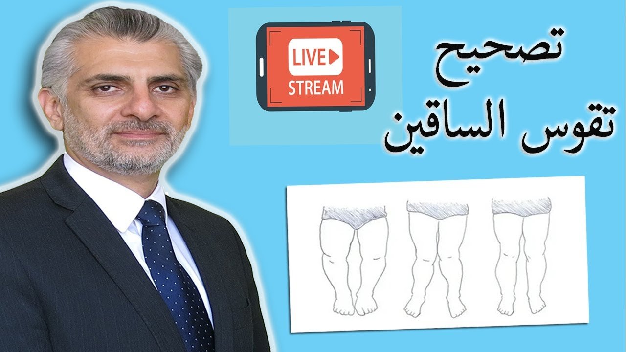 تقوس الساقين