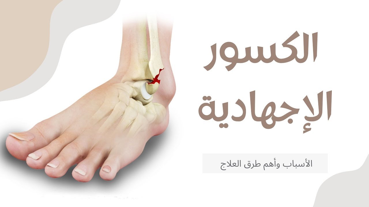 الكسر الاجهادى