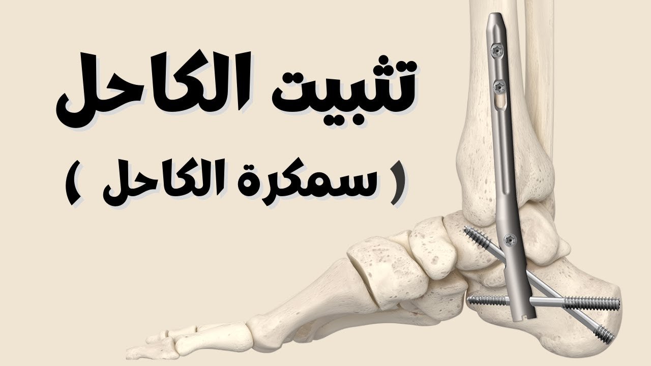عملية تثبيت مفصل الكاحل