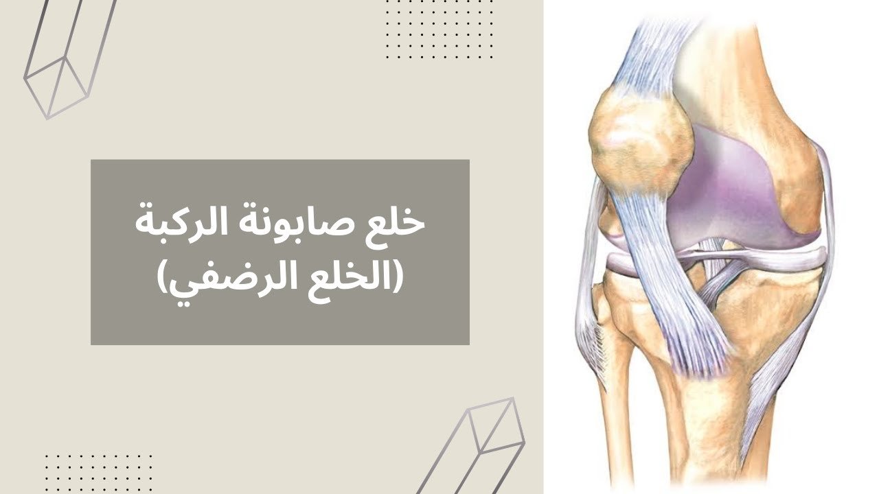 خلع صابونة الركبة