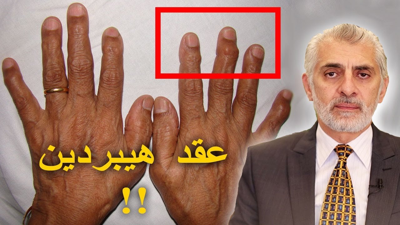 فيديو عن عقد هيبيردن – بروزعظام مفاصل الأصابع – Heberden Nodes