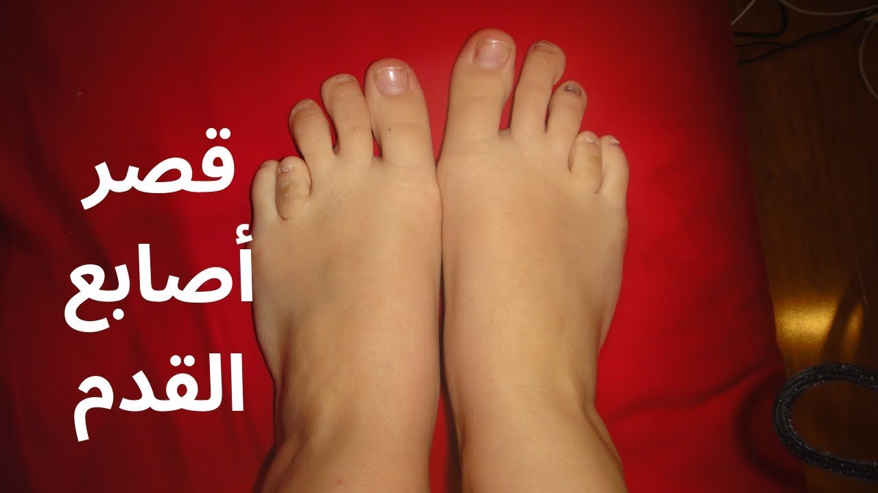 قصر أصابع القدم