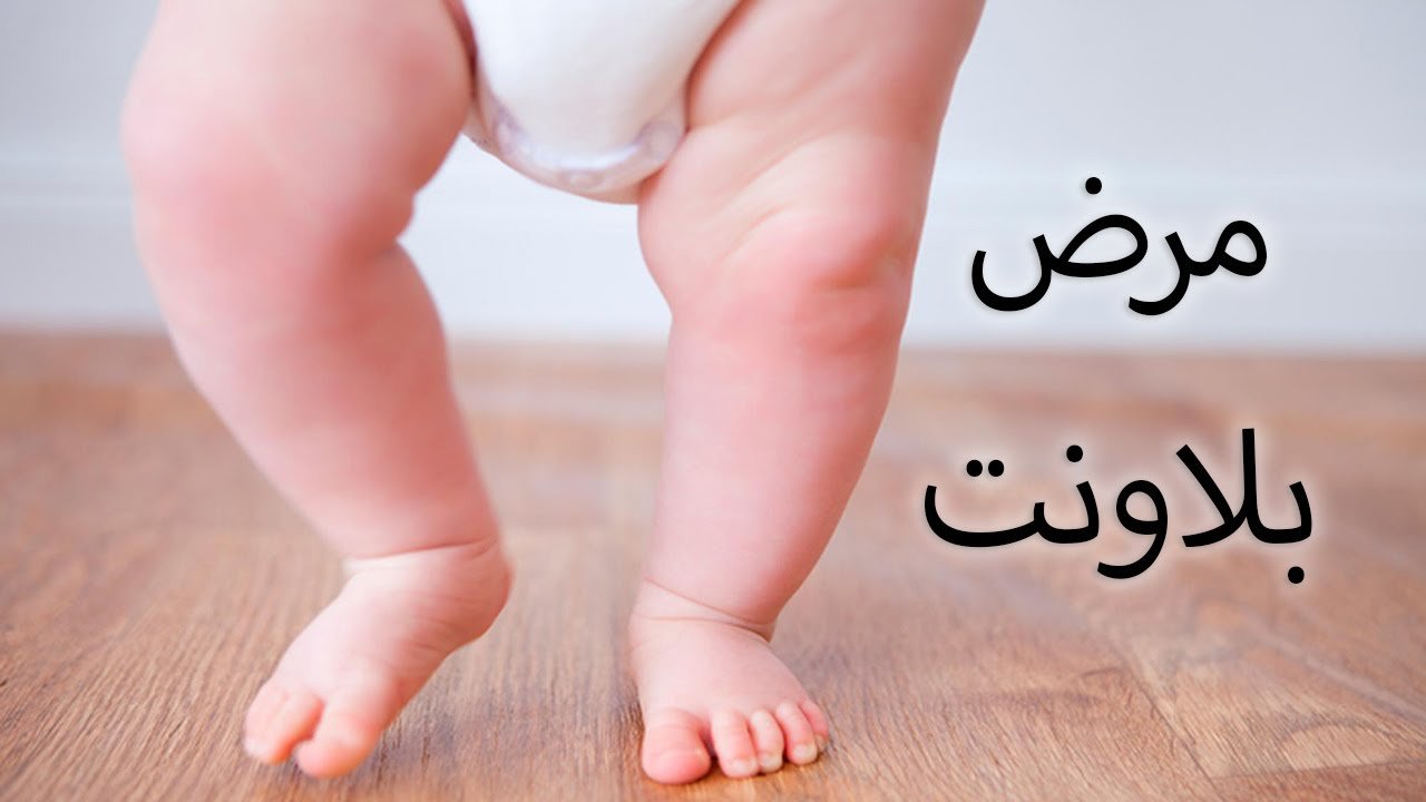 مرض بلاونت عند الاطفال