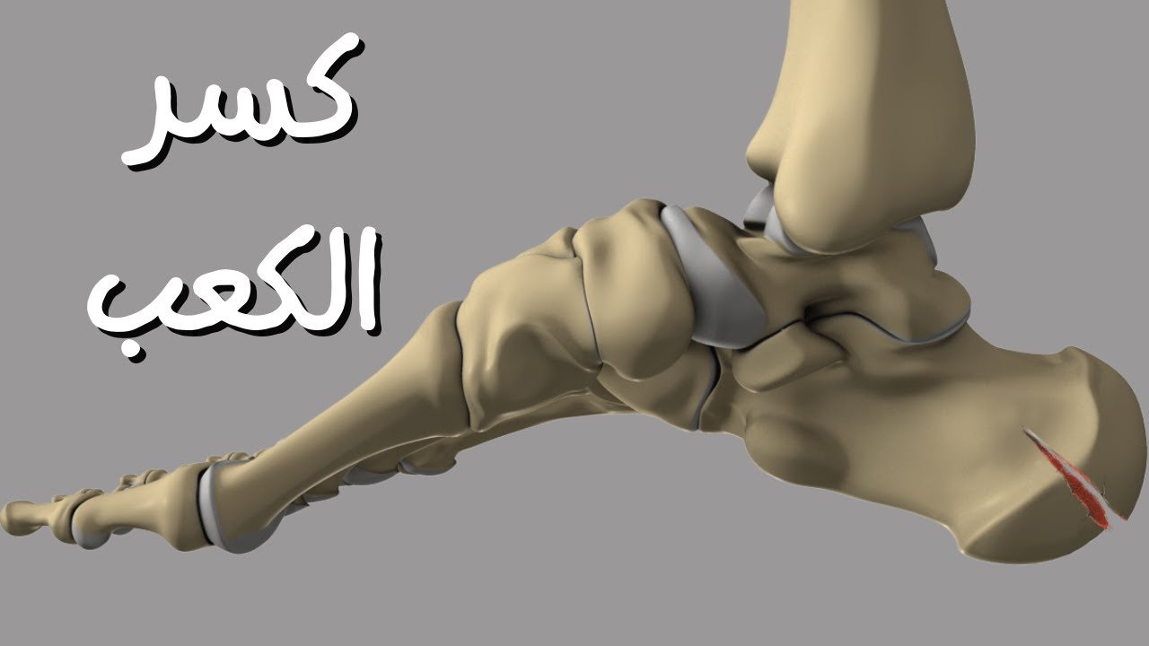 علاج كسر الكعب