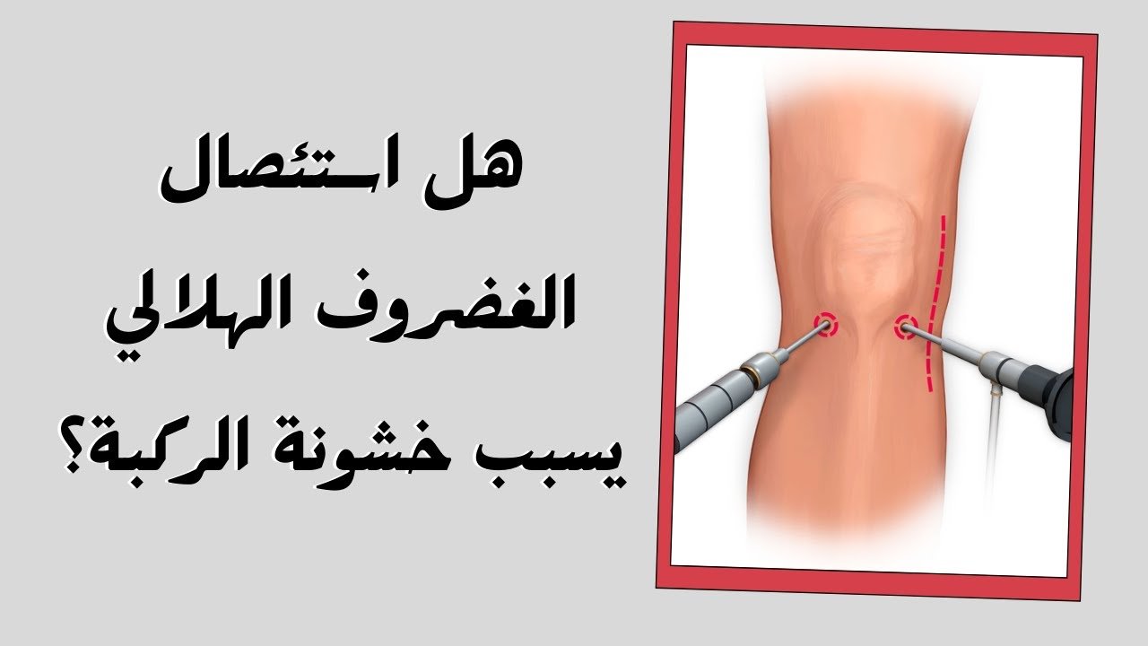 استئصال الغضروف الهلالي