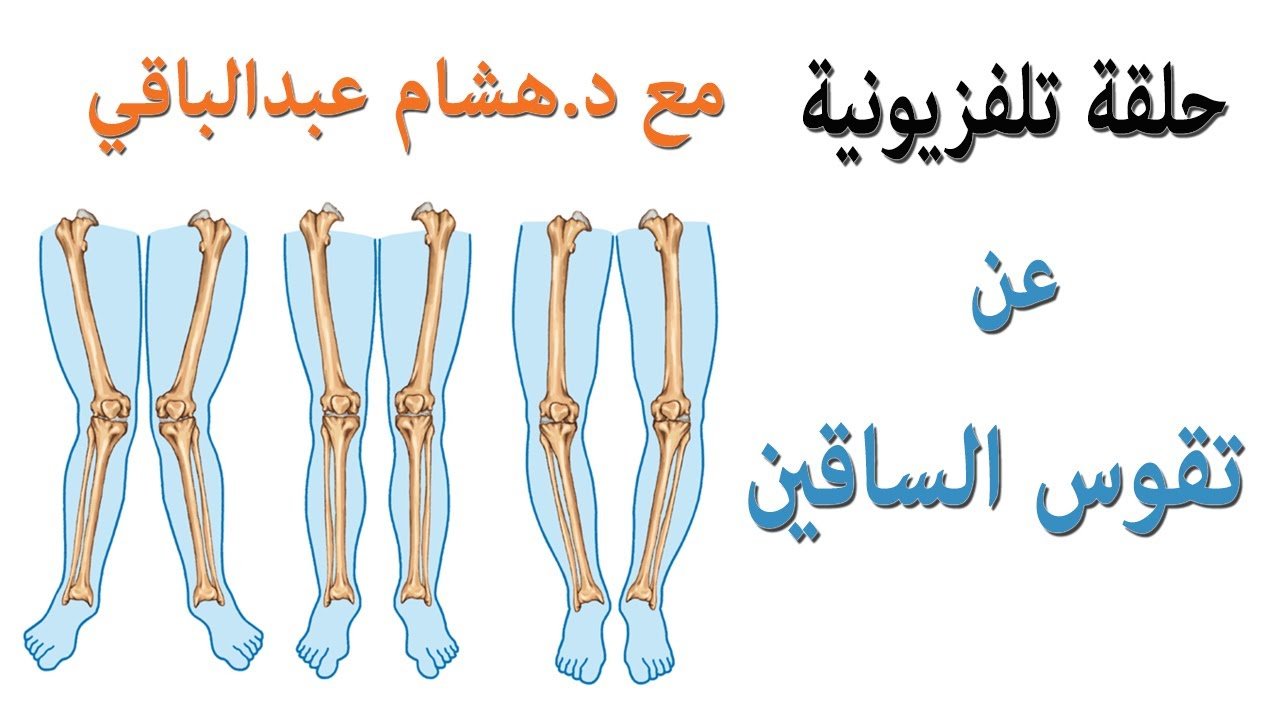 شاهد فيديو عن تقوس الساقين فى الأطفال والكبار – الأسباب والعلاج