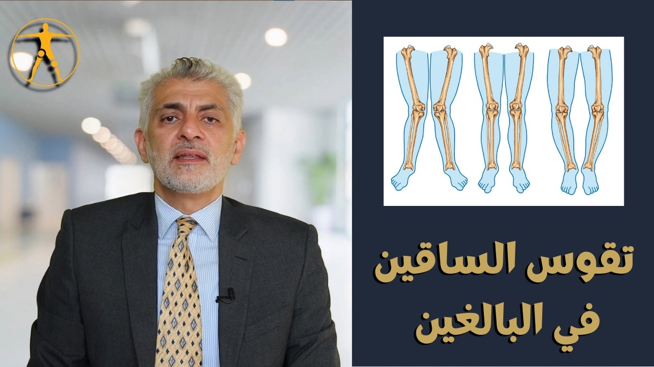 علاج تقوس الساقين عند الكبار | شاهد فيديو د. هشام عبد الباقي