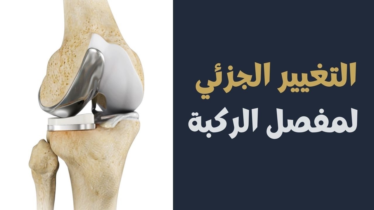 الدكتور هشام عبد الباقي يشرح التغيير الجزئي لمفصل الركبة