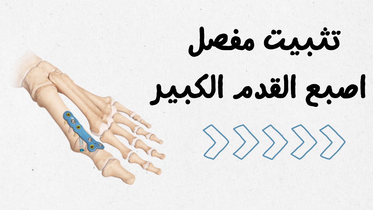عملية تثبيت مفصل إصبع القدم الكبير: متى تُجرى؟
