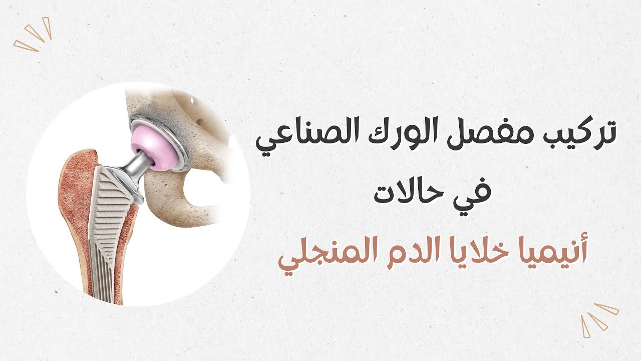 الدكتور هشام عبد الباقي يشرح تركيب مفصل الورك الصناعي في مرضى أنيميا الخلايا المنجلية